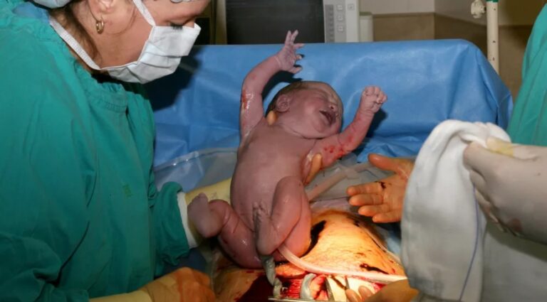 Cesarean-Delivery